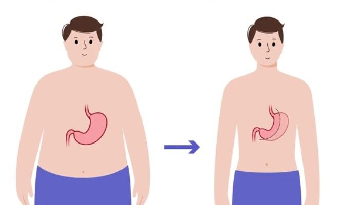 Tüp Mide Ameliyatı Kilo Verme Sürecini Hızlandırıyor